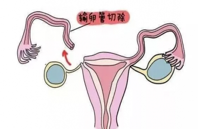 武汉慈铭博鳌国际医院三代试管婴儿，切除双侧输卵管还能做试管婴儿吗？